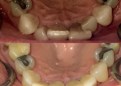 Before & After Dental Filling